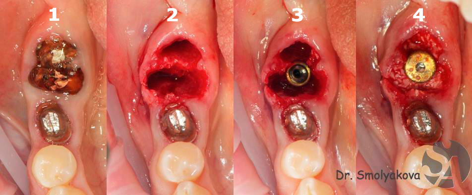 одномоментная имплантация зуба