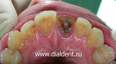 зуб после травмы