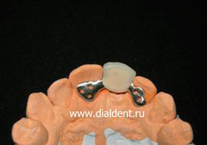 временный протез переднего зуба на модели