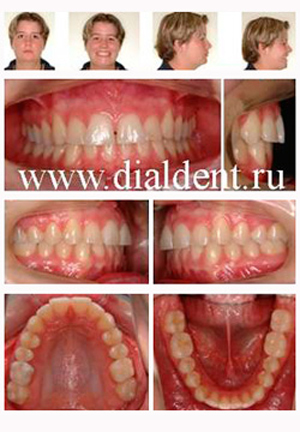 фотофиксация перед имплантацией зубов