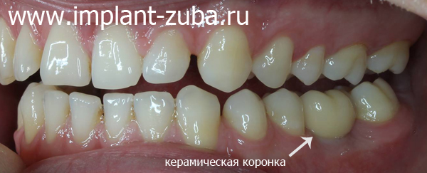 керамическая коронка фото