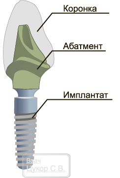 протезирование зубов на имплантах