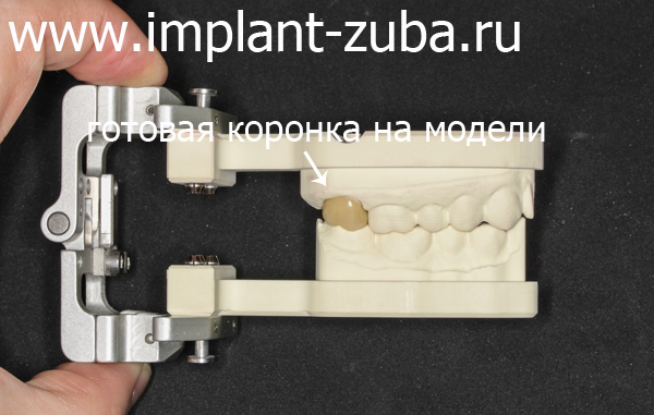 коронка, изготовленная при помощи CAD/CAM технологии