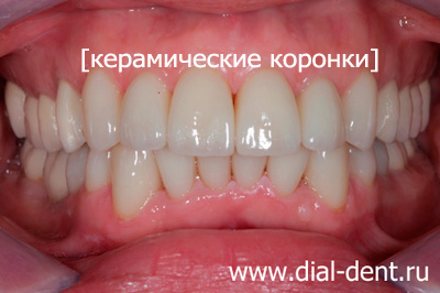 цельнокерамические коронки