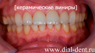 виниры на передние зубы