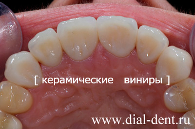 виниры керамические
