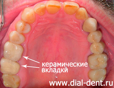 керамическая вкладка